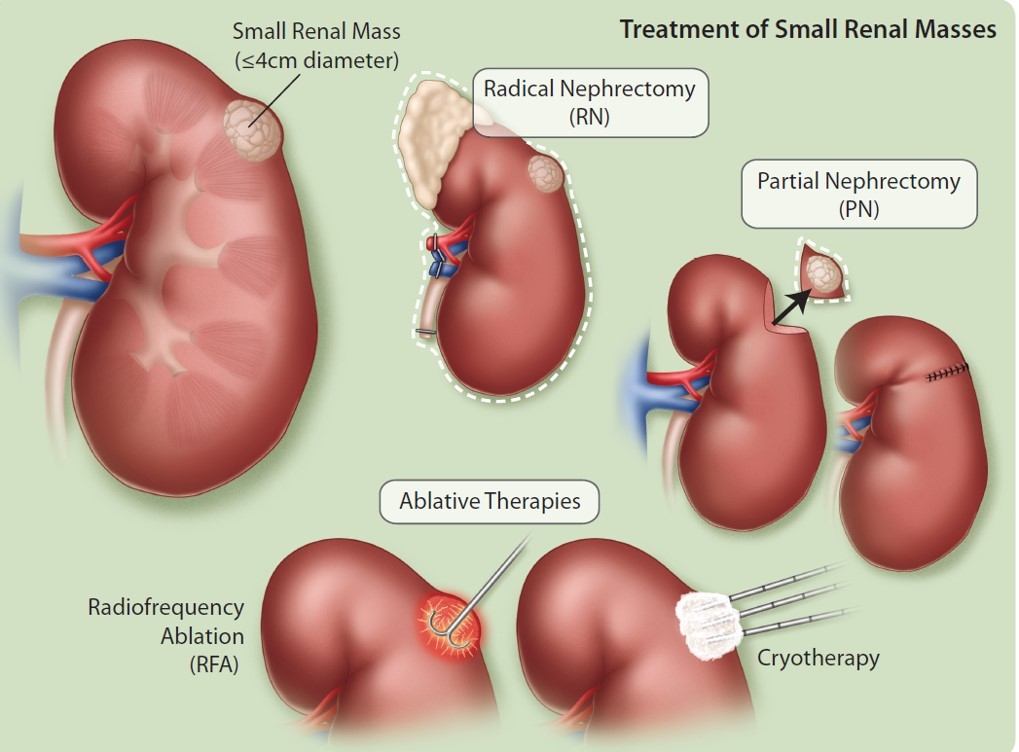 treatment of SRM