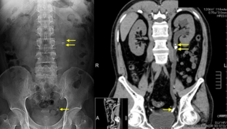 図：尿管結石のレントゲン写真とCT所見