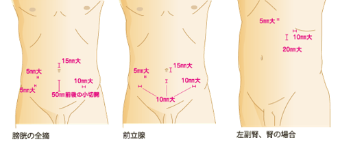 腹腔鏡手術の適応疾患について