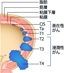 図2：膀胱がんの深達度 （表在性がんと浸潤性がん）