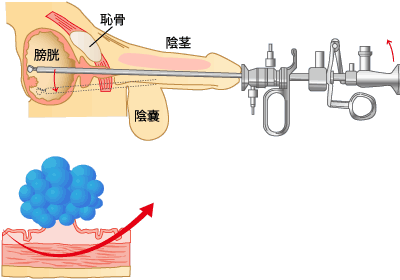 経尿道的膀胱腫瘍切除術