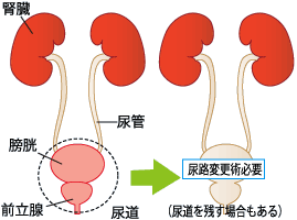 図5：膀胱全摘術