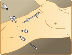 図6：腹腔鏡下膀胱全摘術（イメージ図）