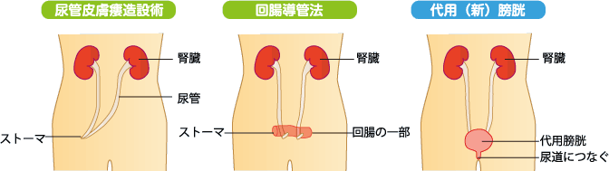 図7：尿路変更の種類
