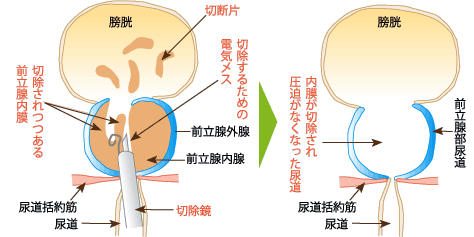 経尿道的前立腺切除術（TUR-P）とは