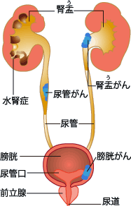 腎盂・尿管がん