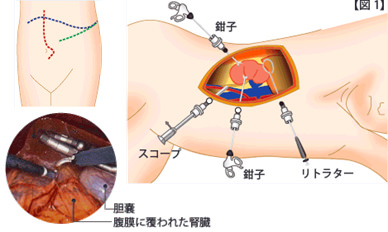 腎部分切除術