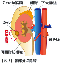 腎部分切除術の流れ