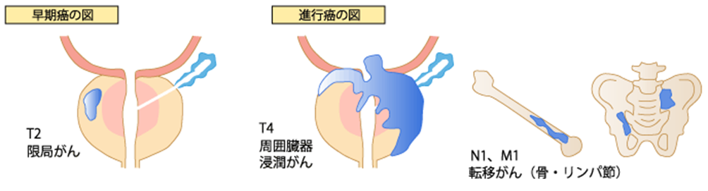 早期癌の図 進行癌の図